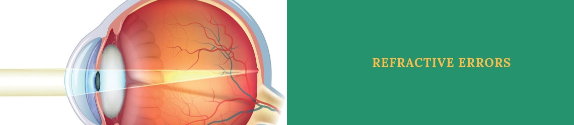 Refractive Errors