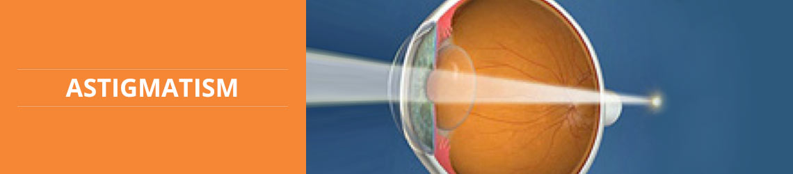 ASTIGMATISM