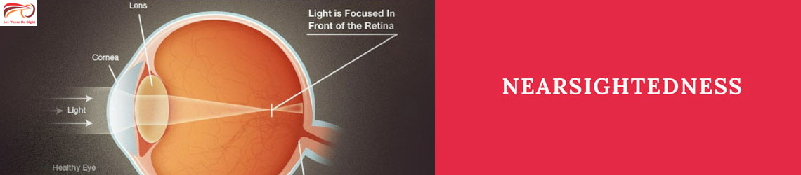 Nearsightedness