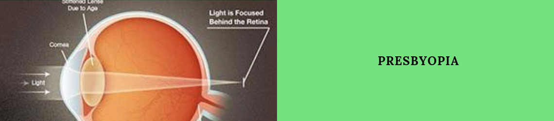 Presbyopia